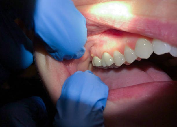 Best Emergency Dental Care for Broken or Chipped Teeth in Desert Edge, CA